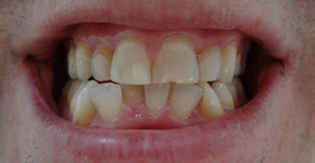 DentoAmerica_Dentist_Cleaning_Whitening